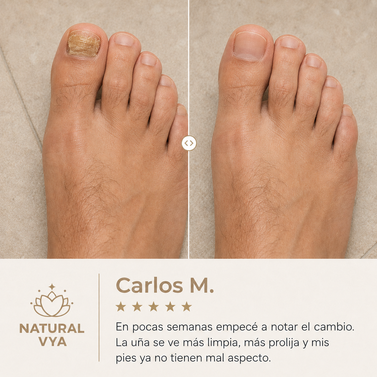 Aceite Para Combatir El Hongo De Las Uñas